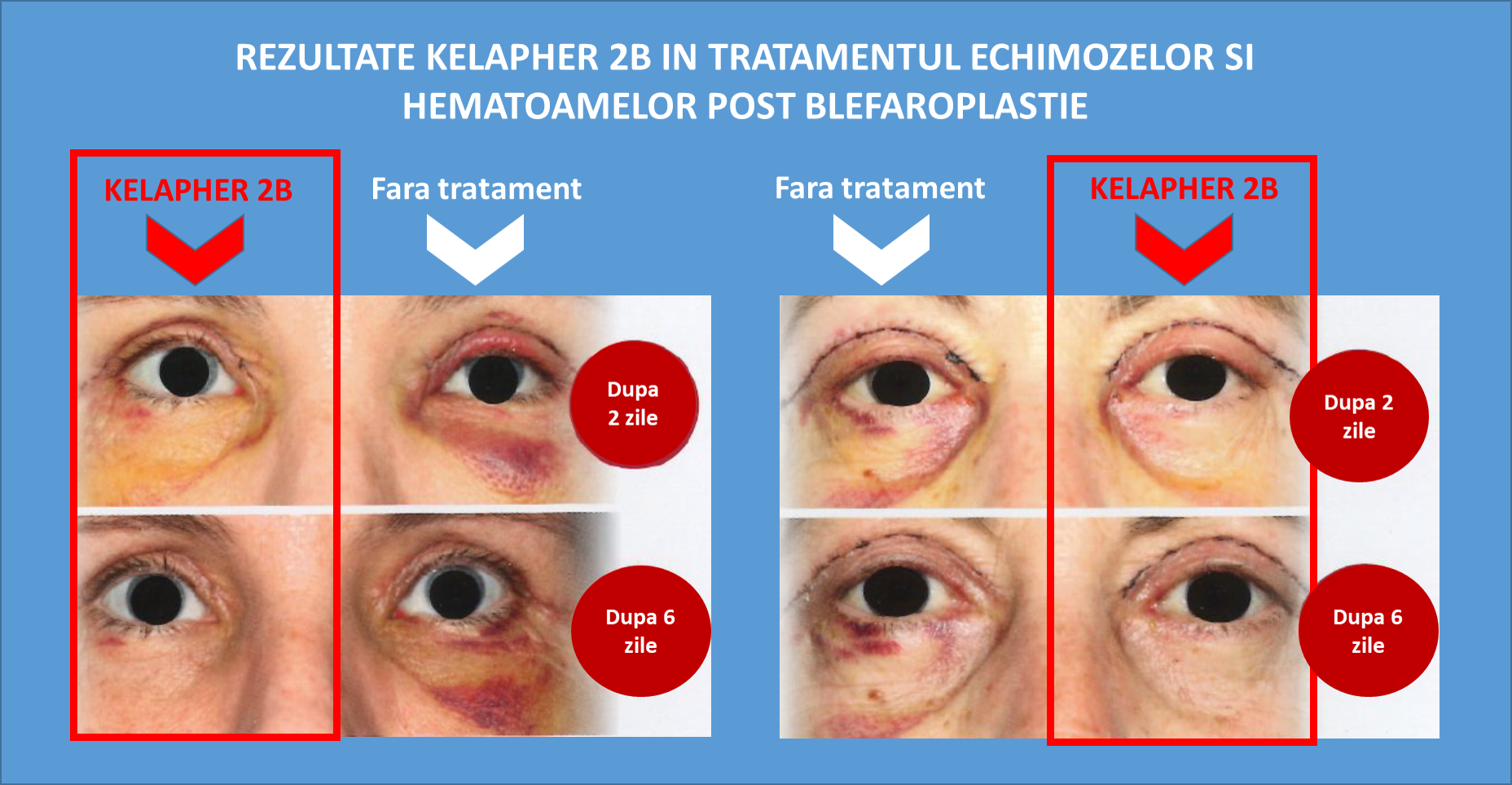 Rezultate Kelapher2B blefaroplastie